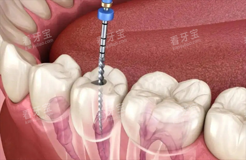根管治疗动画透视图 根管治疗动画透视图
