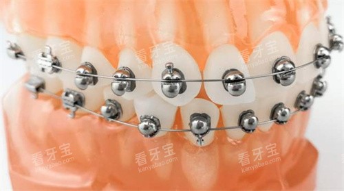 球面自锁托槽矫正 球面自锁托槽矫正
