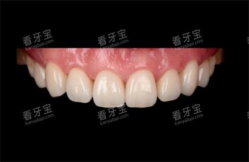 格莱美美学贴面 格莱美美学贴面