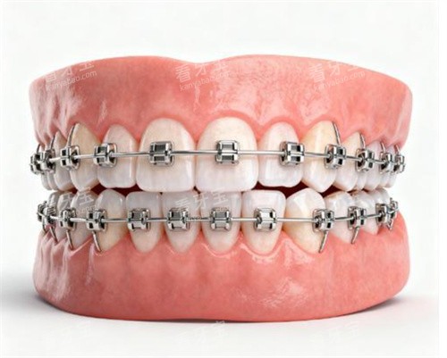 金属矫正牙齿模型图片 金属矫正牙齿模型图片