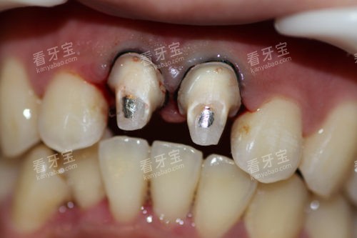 ���ݴ�׮�޸�