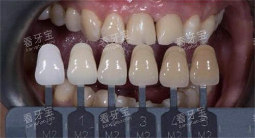 前牙美学修复 前牙美学修复