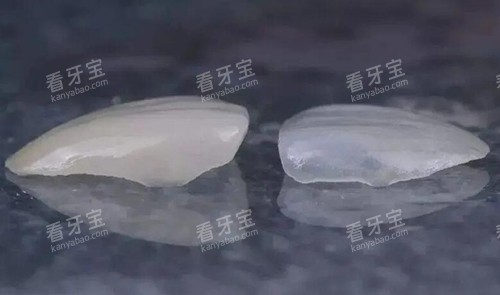 瓷贴面修复对比 瓷贴面修复对比