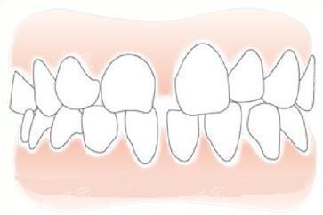 正畸后牙缝示意图 正畸后牙缝示意图