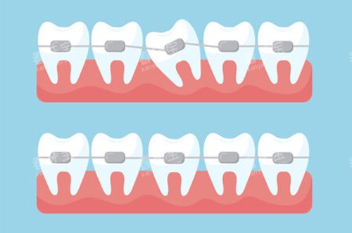 正畸过程图 正畸过程图