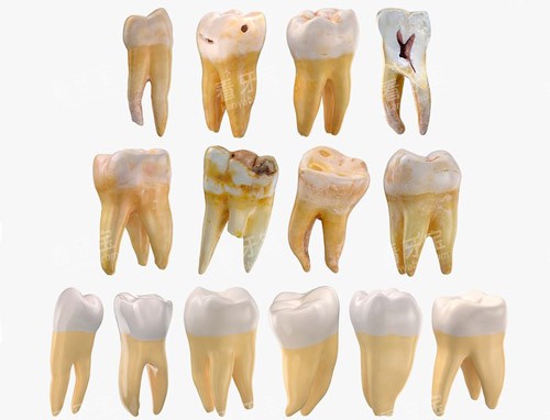 牙齿龋坏磨损 牙齿龋坏磨损