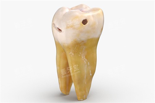 龋坏的六龄齿 龋坏的六龄齿