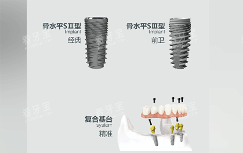 安联种植牙用起来怎么样 安联种植牙用起来怎么样