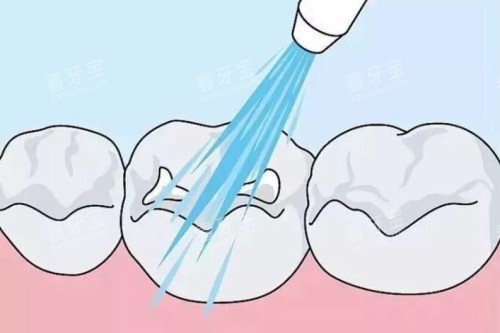 儿牙涂氟卡通图 儿牙涂氟卡通图