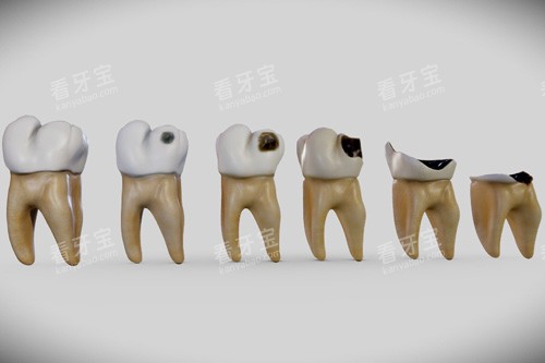 牙齿龋坏过程 牙齿龋坏过程