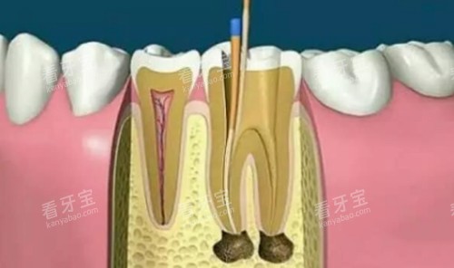 根管治疗动画演示 根管治疗动画演示