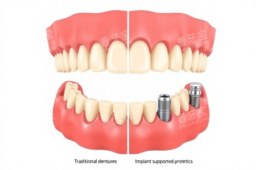 种植牙牙颌动画图 种植牙牙颌动画图