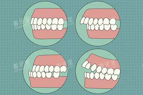 需要牙齿矫正的问题示意图 需要牙齿矫正的问题示意图