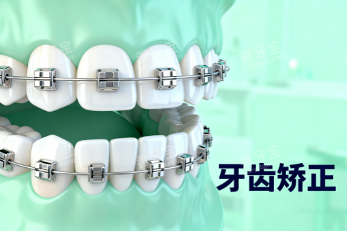 传统牙齿矫正方式展示 传统牙齿矫正方式展示