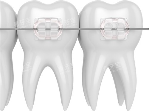 牙齿矫正陶瓷托槽漫画图 牙齿矫正陶瓷托槽漫画图