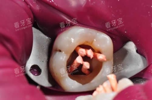 根管治疗细节图片 根管治疗细节图片