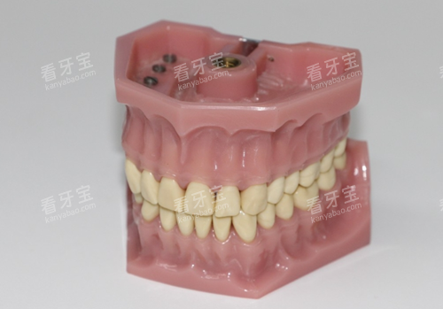 全口假牙 全口假牙