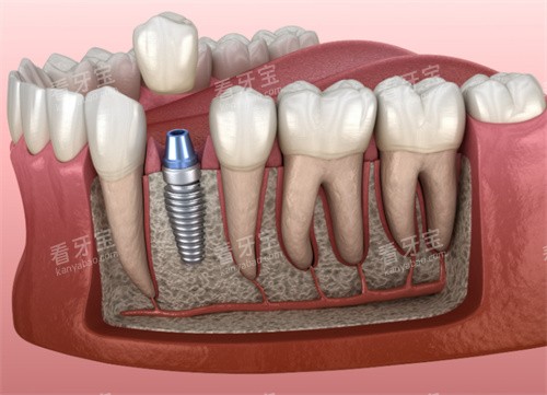 种植牙解剖模型 种植牙解剖模型