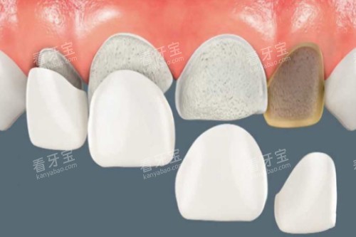 牙贴面卡通图片展示 牙贴面卡通图片展示