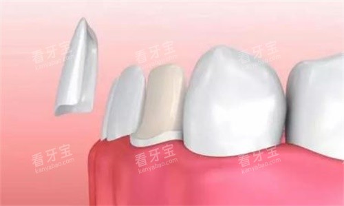 牙贴面示意图 牙贴面示意图