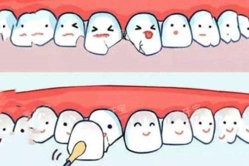 牙贴面卡通图 牙贴面卡通图