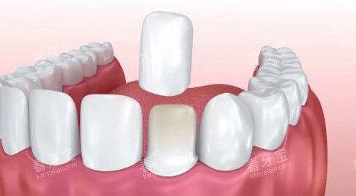 卡通图示意牙贴面改善 卡通图示意牙贴面改善