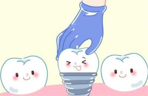 种植体动画图 种植体动画图