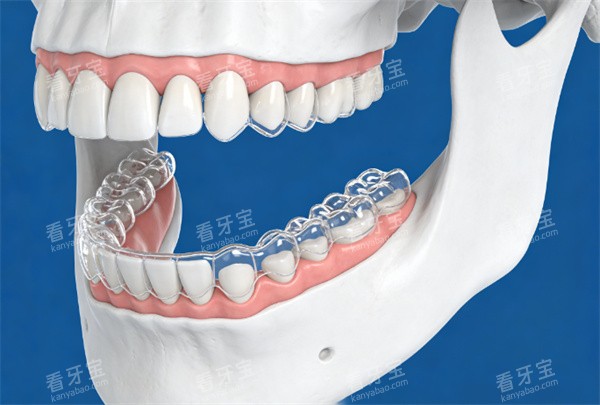 牙齿隐形矫正示意图展示 牙齿隐形矫正示意图展示