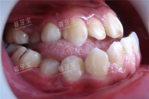 地包天牙齿照片 地包天牙齿照片