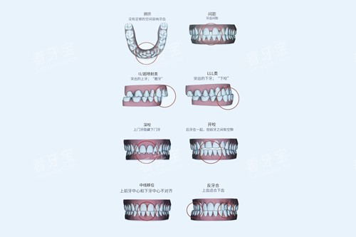 牙齿不齐的不同类型表现图 牙齿不齐的不同类型表现图