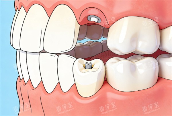 牙齿缺失插画示意图展示 牙齿缺失插画示意图展示