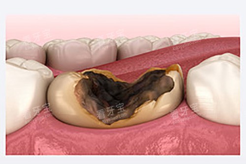 牙齿龋坏图片模型示意图 牙齿龋坏图片模型示意图