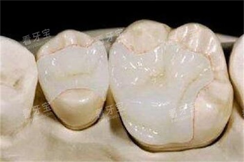 牙齿修复改善照片图 牙齿修复改善照片图