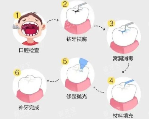 补牙具体步骤图 补牙具体步骤图