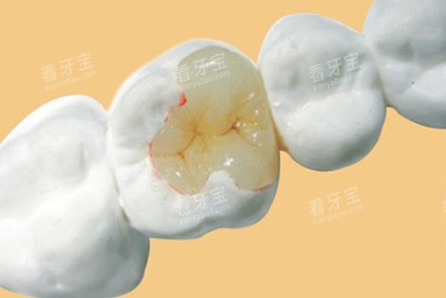 补牙示意图 补牙示意图