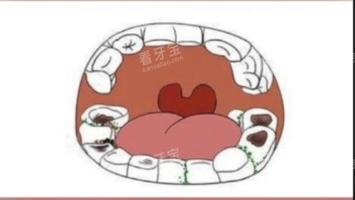 牙齿腐蚀漫画示意图 牙齿腐蚀漫画示意图