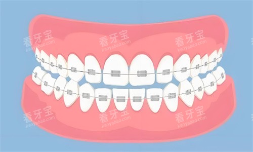 金属矫正牙齿 金属矫正牙齿
