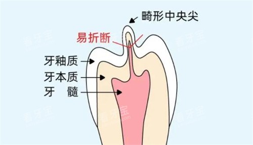 牙齿畸形中央尖卡通图展示 牙齿畸形中央尖卡通图展示