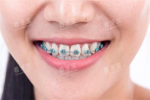 牙齿正畸宣传 牙齿正畸宣传