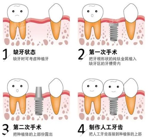 种植牙后的成效.jpg 种植牙后的成效.jpg