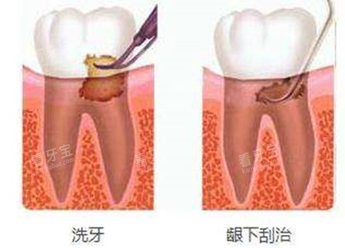 洗牙和龈下刮治对比示意图 洗牙和龈下刮治对比示意图
