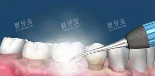 洗牙卡通示意图 洗牙卡通示意图