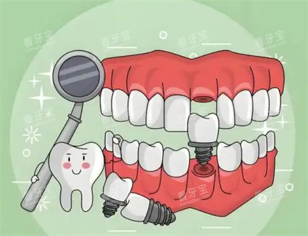 种植牙齿图片.jpg 种植牙齿图片.jpg