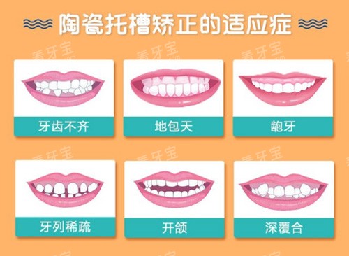 陶瓷半隐形矫正适应症.jpg 陶瓷半隐形矫正适应症.jpg