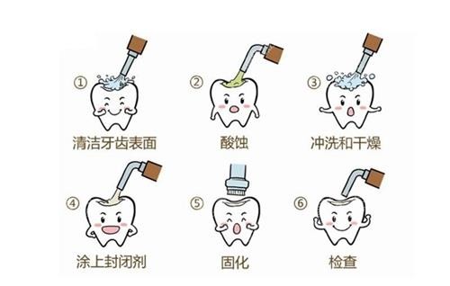 窝沟封闭流程图.png 窝沟封闭流程图.png