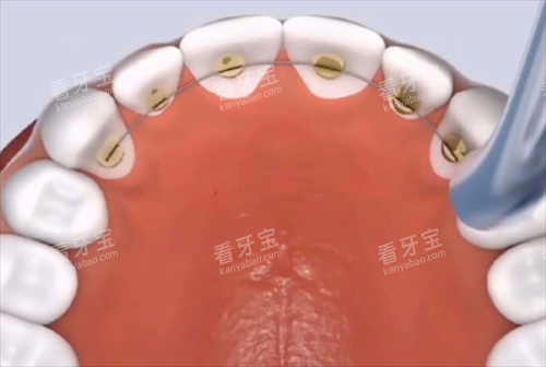舌侧矫正动画模拟.png 舌侧矫正动画模拟.png