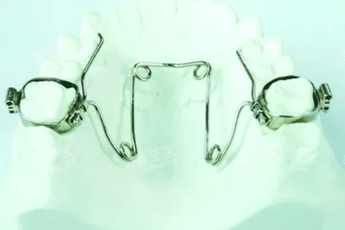 牙齿扩弓器图.gif 牙齿扩弓器图.gif