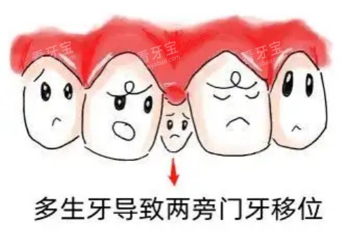 门牙多生牙卡通图.jpg 门牙多生牙卡通图.jpg
