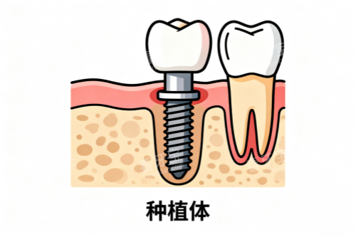 缺牙修复卡通展示图.png 缺牙修复卡通展示图.png