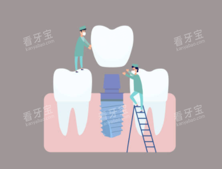 种植牙检查示意图 种植牙检查示意图